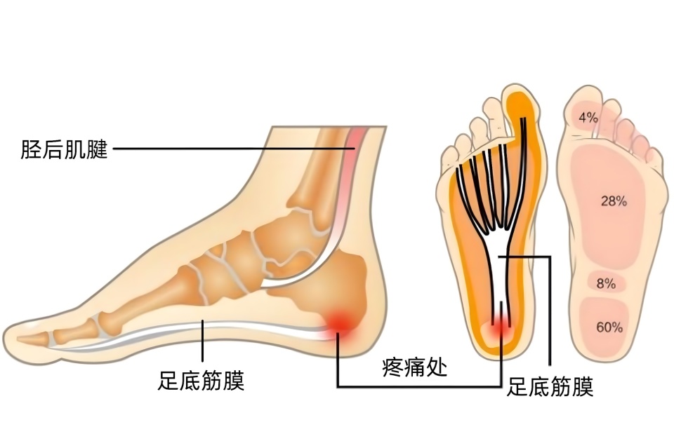 脚后跟不红不肿,但一走路就痛?足底筋膜炎如何缓解疼痛和预防?