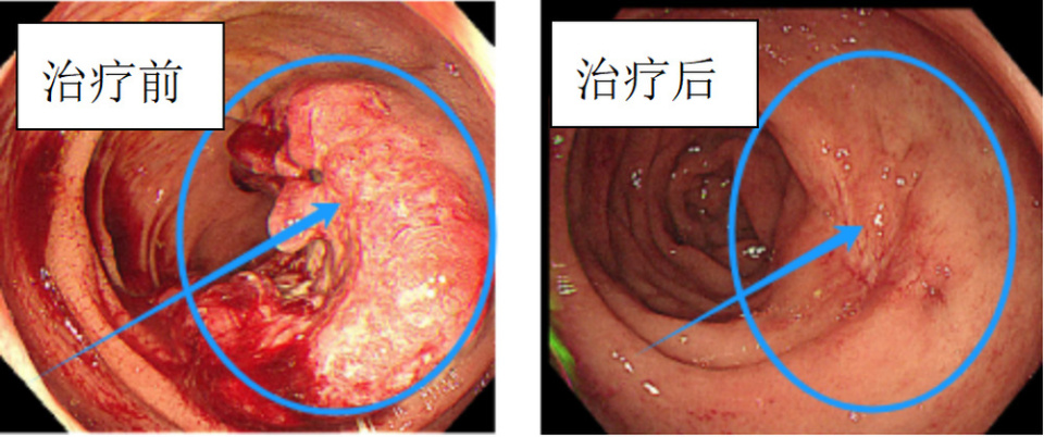 直肠乳头状腺癌图片