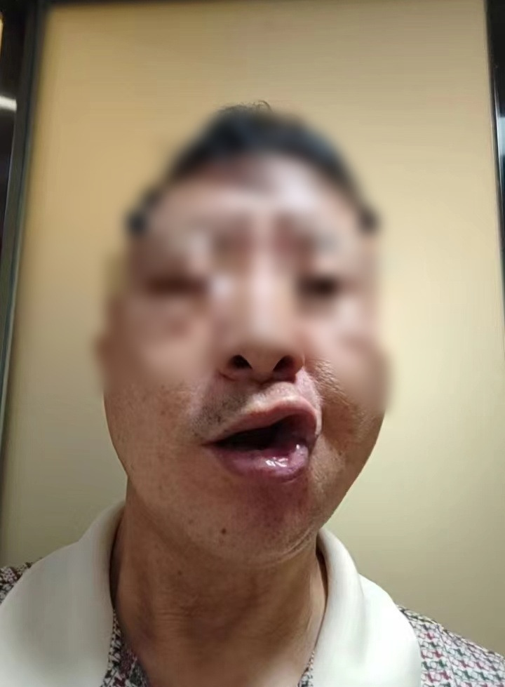 健康小站 | 大伯"花式"避暑,不料被"面瘫"找上门