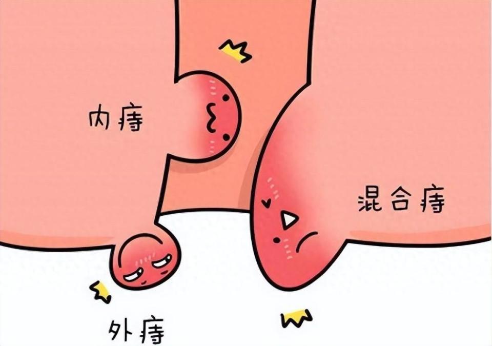 为啥你的痔疮了?教你6个应对方法,必要时选择手术治疗!