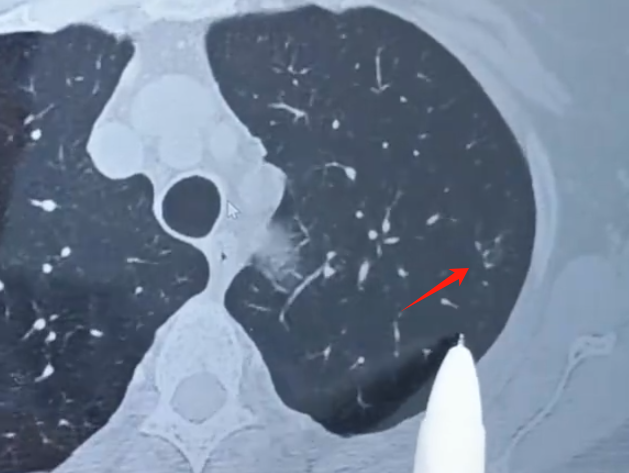 会导致肺部组织发生一定的改变,从而在ct图像上呈现出磨玻璃结节影