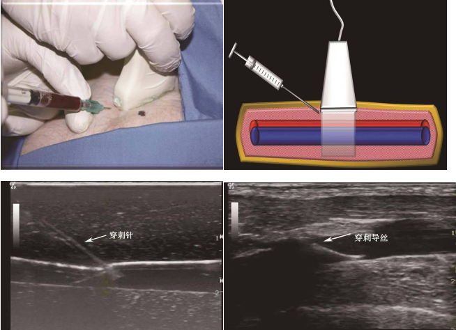 导丝怎么扩规培临床技能：中心静脉置管术全攻略之超声引导下锁骨下静脉穿刺置管术（8）_https://www.jmylbn.com_新闻资讯_第9张