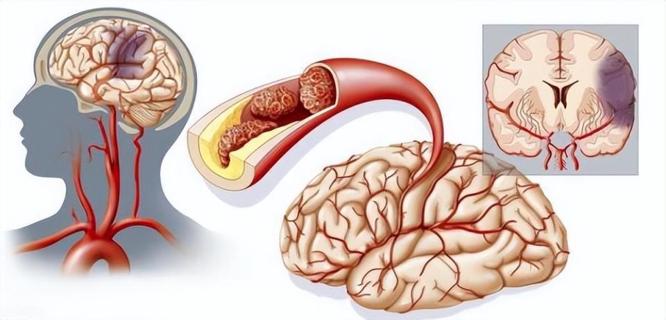 缺血性脑卒中怎么回事?医生提醒:出现这些症状,及时就医!