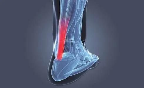 被脚后跟疼折磨苦不堪言者请看过来