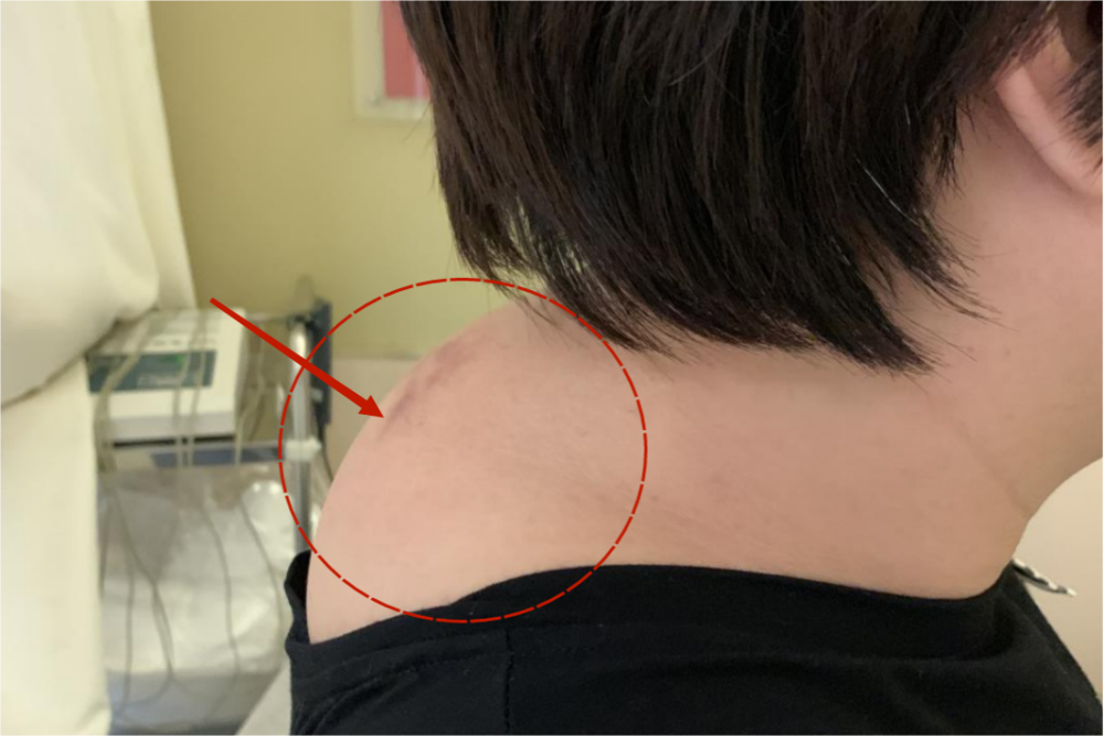 脖子后面长了难看的富贵包如何消除教你3个简单动作改善