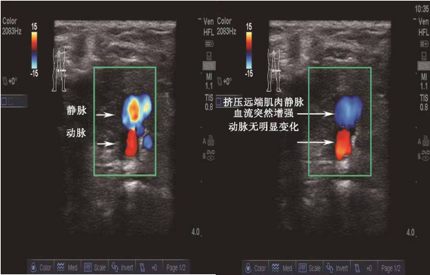 导丝怎么扩规培临床技能：中心静脉置管术全攻略之超声引导下锁骨下静脉穿刺置管术（8）_https://www.jmylbn.com_新闻资讯_第6张