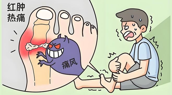 如何应对痛风急性发作?出现4个症状,及时就医!