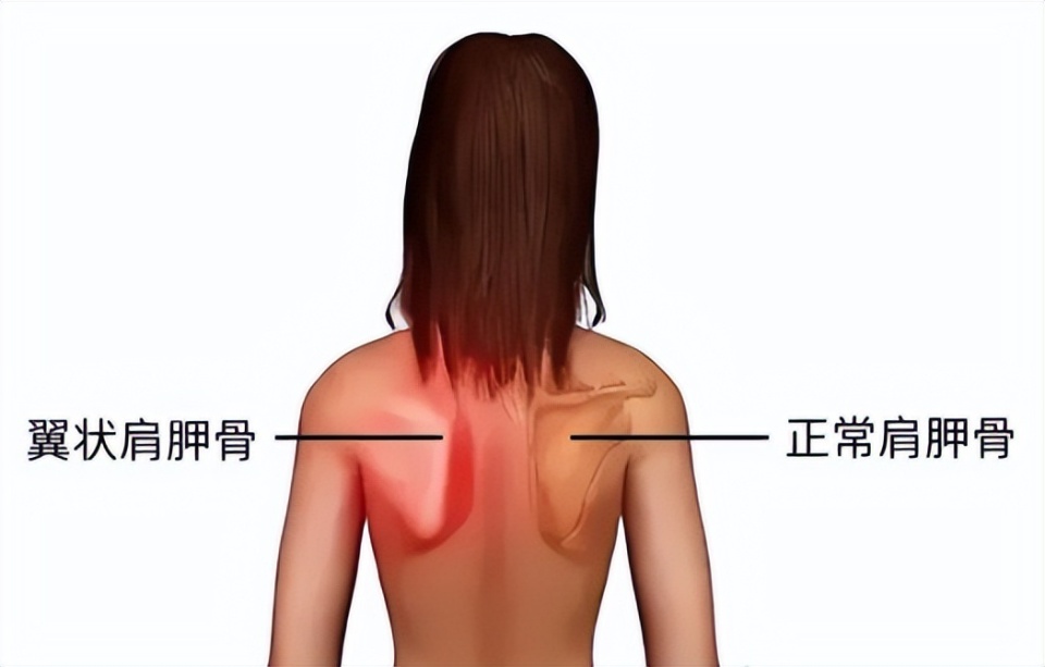 孩子明明挺直了身体,但从侧面看还是"驼背",怎么解决?