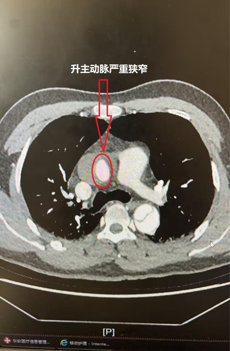 小伙遇上致命主动脉夹层 ,医院开通"绿色通道"紧急手术成功"拆弹"