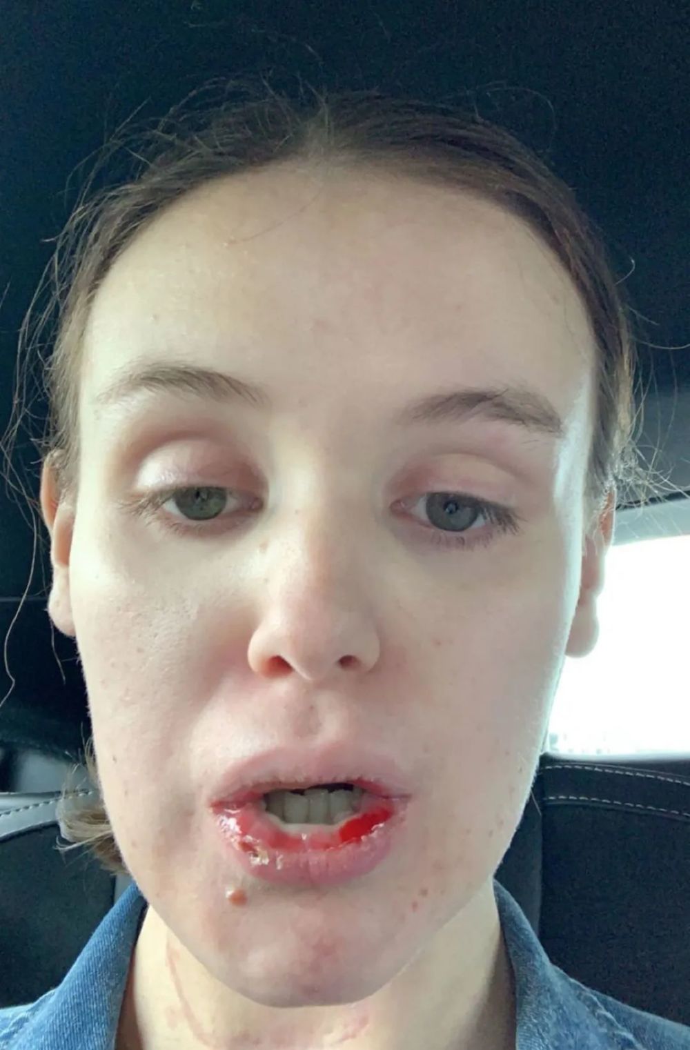 妹子患舌癌被迫割舌保命,医生用她大腿肌肉,为她再造了个舌头!