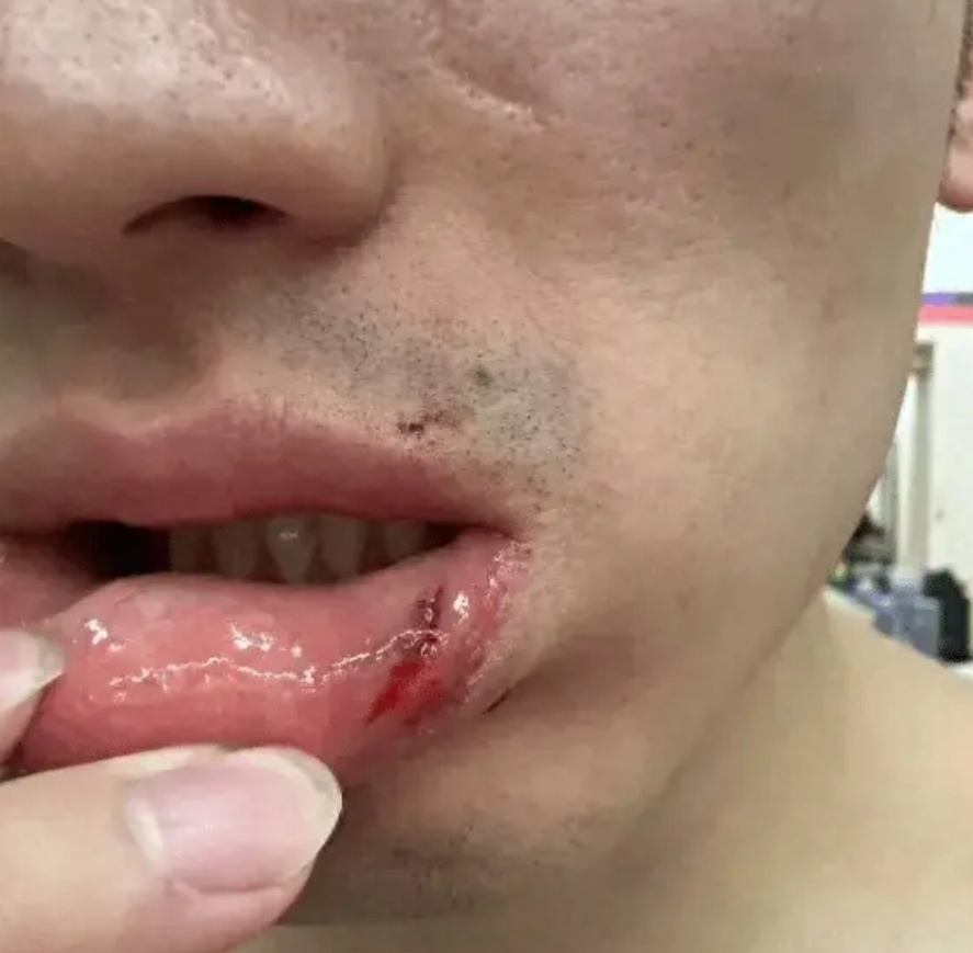 打脸杨鸣!被质疑假摔?于德豪嘴唇破相曝光真相,辽宁下手重了点