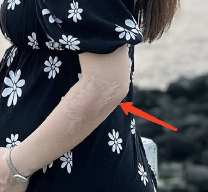 拍摄《我和春天有个约会》的时候,现场起火,selina烧伤面积多达54%