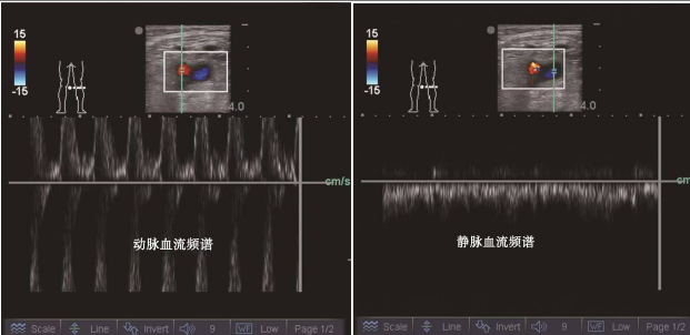 导丝怎么扩规培临床技能：中心静脉置管术全攻略之超声引导下锁骨下静脉穿刺置管术（8）_https://www.jmylbn.com_新闻资讯_第7张