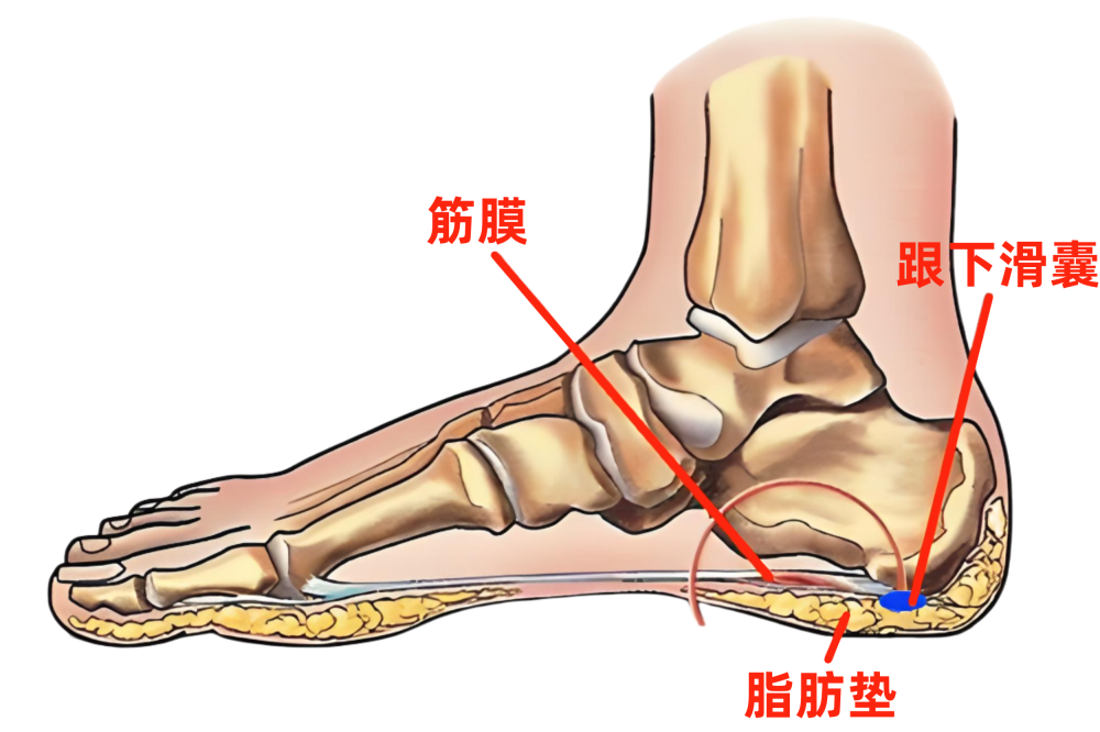 5,痛风脚后跟是痛风常见的受累部位之一,由于尿酸排泄减少或合成增多