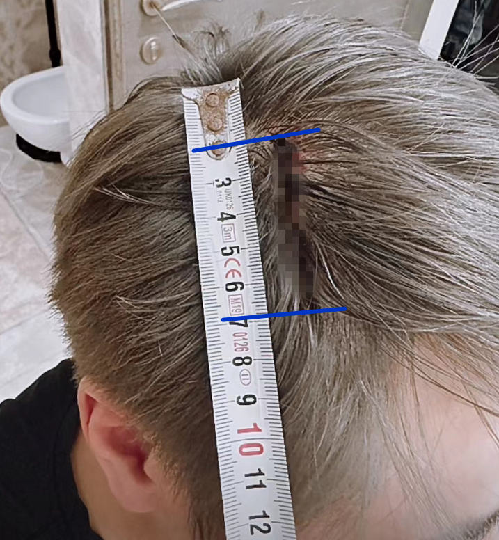 被高尔夫球打到头破血流,伤口长达5厘米_腾讯新闻