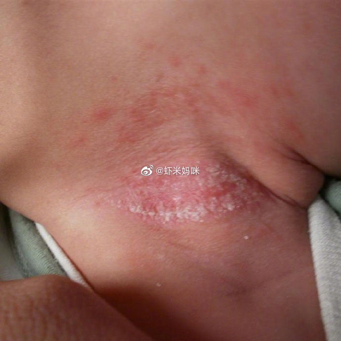 婴儿脖子汗疱疹图片