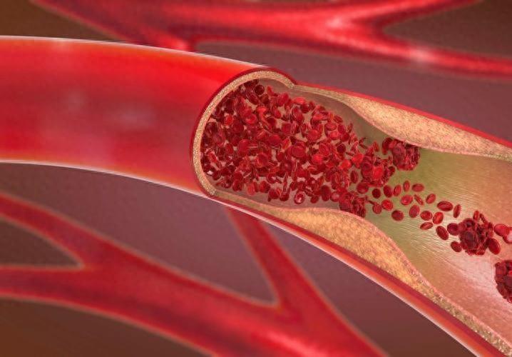 长时间静坐,卧床,小心的静脉血栓!别不当回事,做好早期预防