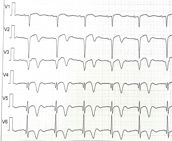 健康小站丨66岁大妈参加免费居民体检心电图结果却吓坏众人