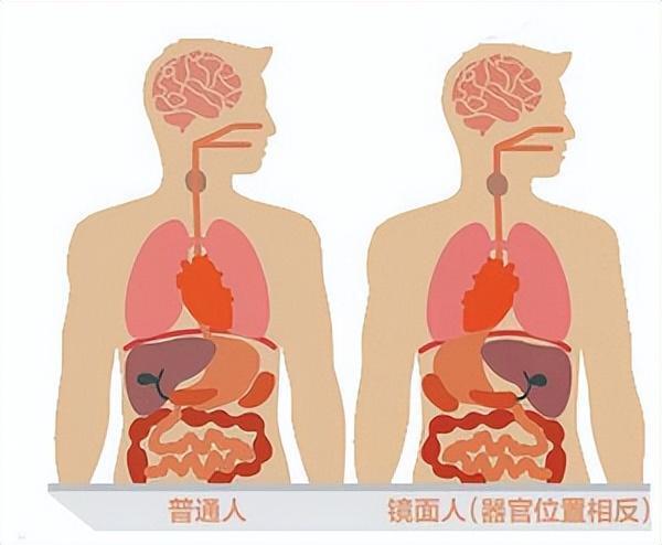 罕見鏡面人內臟反著長醫生手術也得反著來