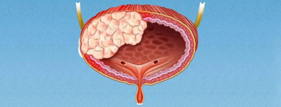 膀胱癌的早期症状图图片