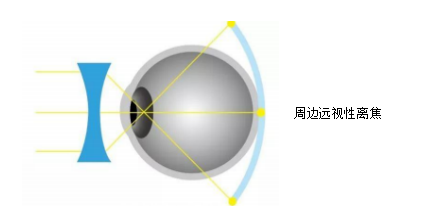 防控近视的离焦眼镜有用吗？_腾讯新闻