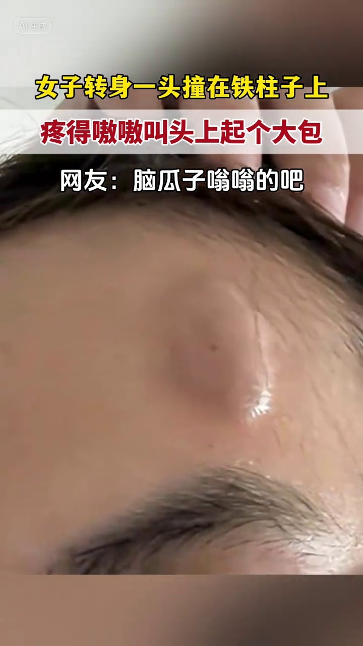 女子一头撞在铁柱子上,疼的嗷嗷叫头上瞬间起个大包