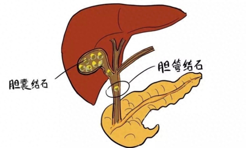 胆结石怎么形成的？医生提醒：避免这7个因素，保护胆囊健康_腾讯新闻