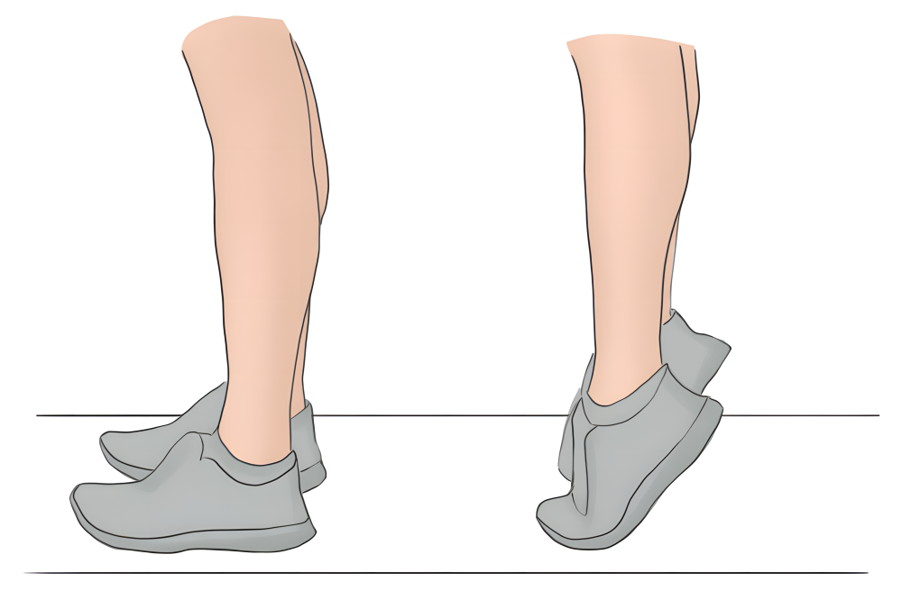 长短腿也有真假之分这篇文章会详细教你自测和矫正方法