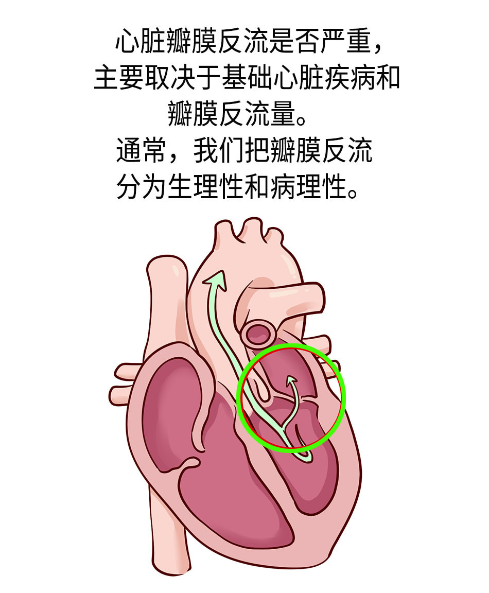 體檢發現的心臟瓣膜反流是什麼?要緊嗎?_騰訊新聞