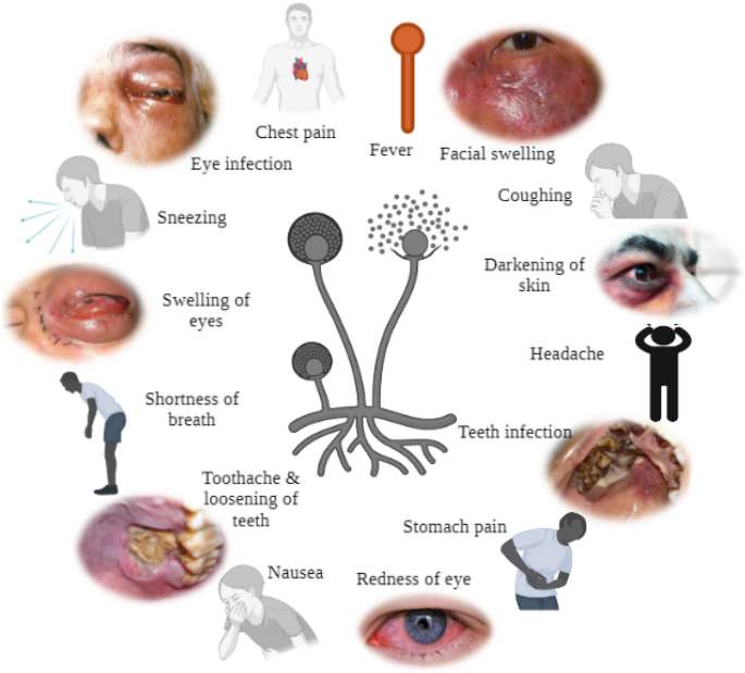 毛霉菌会侵入血管,引起血栓,造成周围组织缺血,梗死和