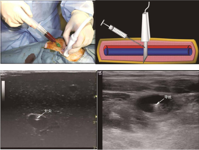 导丝怎么扩规培临床技能：中心静脉置管术全攻略之超声引导下锁骨下静脉穿刺置管术（8）_https://www.jmylbn.com_新闻资讯_第10张