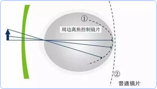 防控近视的离焦眼镜有用吗？_腾讯新闻