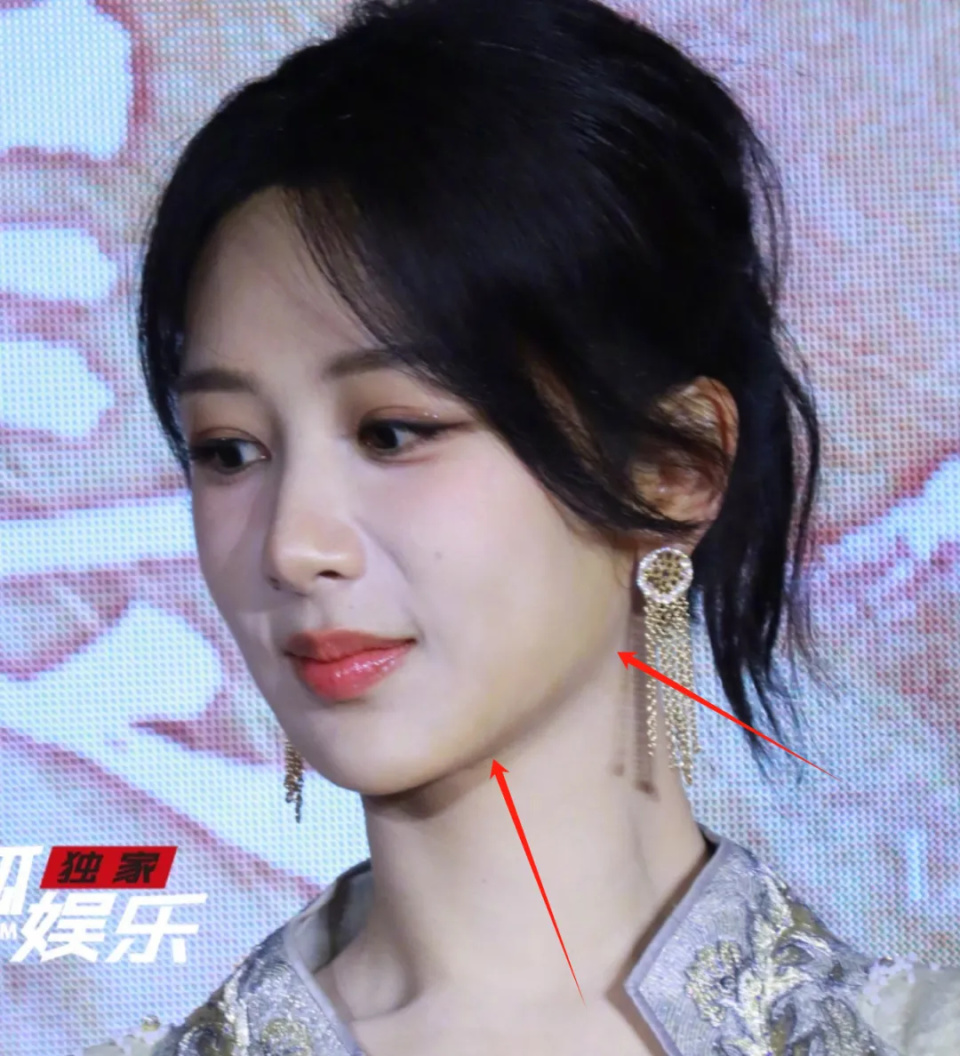整个鼻基底看起来非常不自然,法令纹也让她看上去老了1