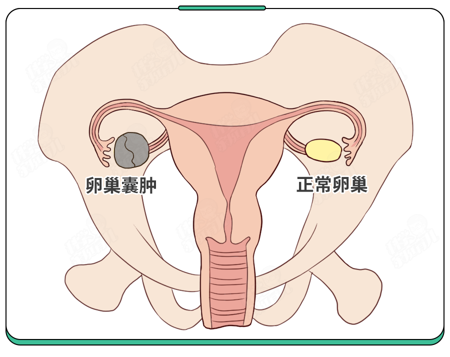 卵巢巧克力囊肿PPT图片