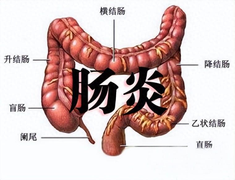 何为肠炎?要如何正确治疗?日常饮食注意什么?