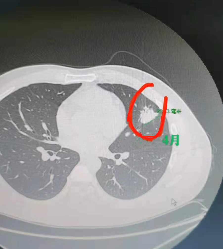 肺结节就怕悄悄变大!拖了1年,复发转移几率变大了