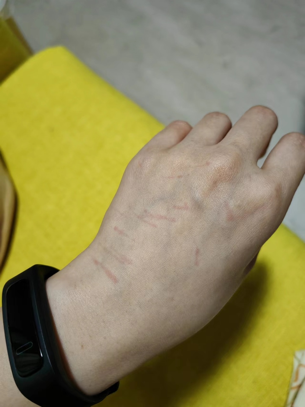 我家狗看着挺正常被它抓伤会得狂犬病吗5针疫苗必须都打完吗