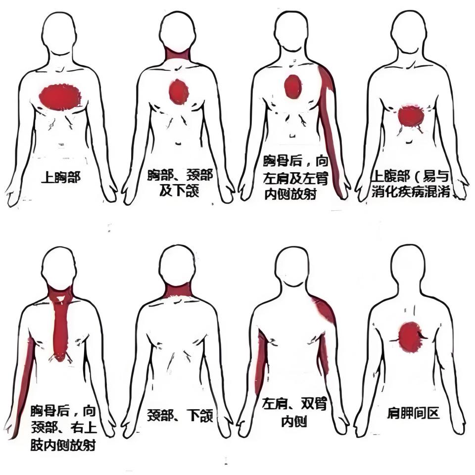 心绞痛发作,疼痛的时间有多长?五要点助你识别心绞痛