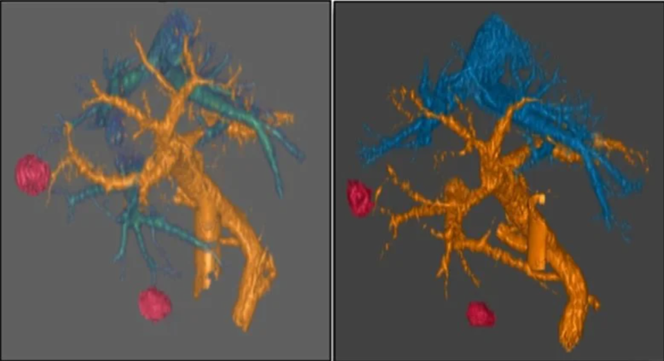 胰腺癌新药“达拉西布”三期数据亮眼 中位生存期翻倍延长