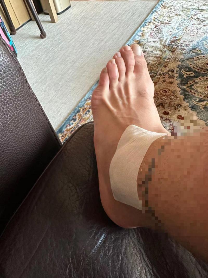 训练中崴脚 受伤脚踝已逐渐消肿