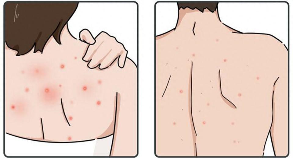 瘙痒?还伴随脱发?毛囊炎在作怪!找出元凶,做好预防