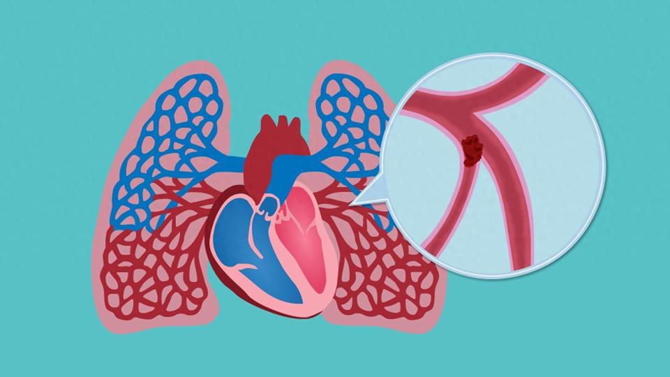 久坐办公,肺栓塞正潜伏在长时间久坐后——做好早期预防_腾讯新闻