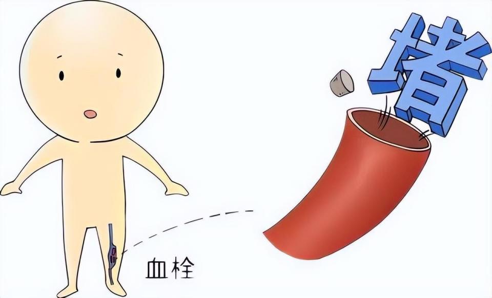 血栓长时间不管，危害不小！做好早期预防，别等出现症状再去治疗_腾讯新闻