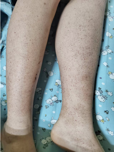 孩子腿上斑点可能是这种疾病的信号,感冒后尤其要注意