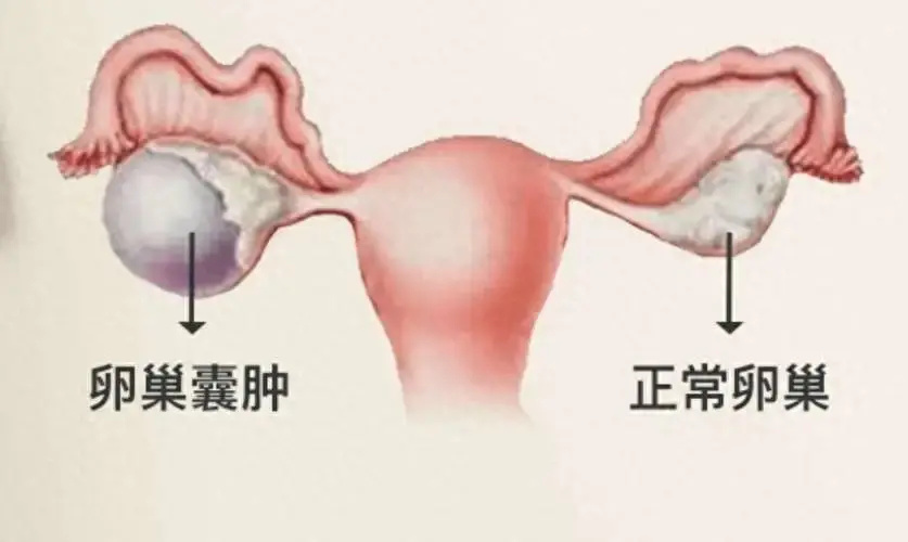 卵巢囊性结构图片