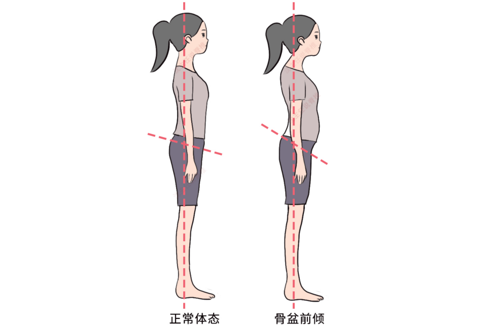 很多人羡慕前凸后翘的身材,可能是"骨盆前倾"问题!