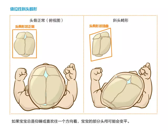 孩子的头睡扁了怎么办？医生妈妈教你“圆”回来_腾讯新闻