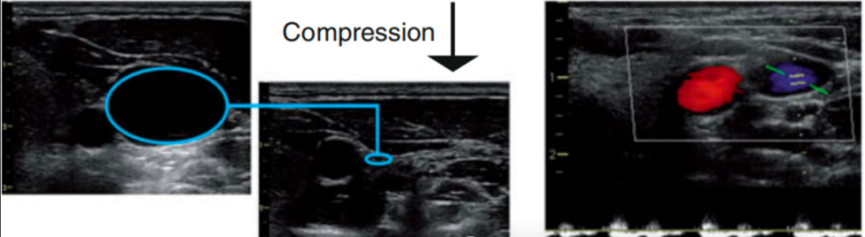 导丝怎么扩规培临床技能：中心静脉置管术全攻略之超声引导下锁骨下静脉穿刺置管术（8）_https://www.jmylbn.com_新闻资讯_第8张