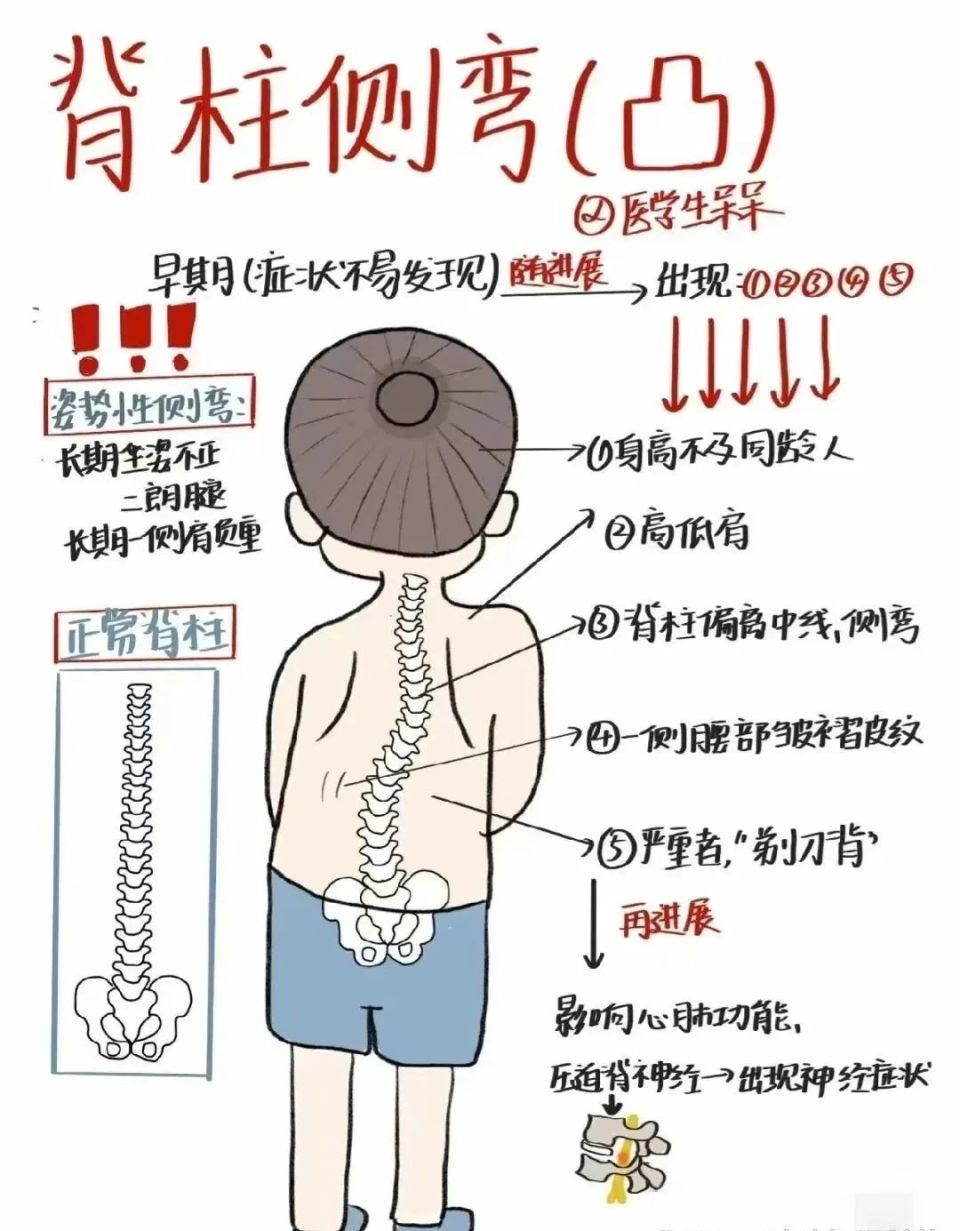 能康暑期青少年脊柱侧弯矫正,让孩子不走"弯"路