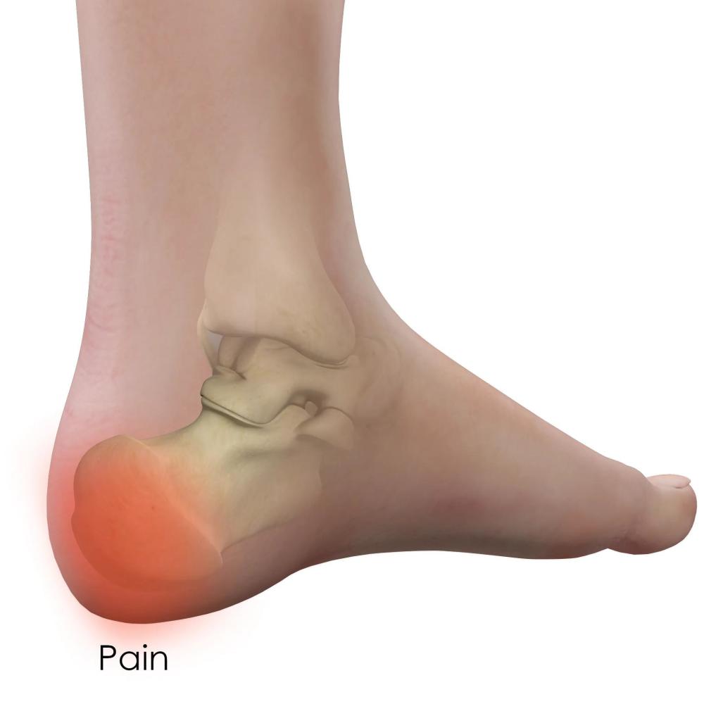 劳损性的疾病,它的原因有很多,而常见的原因就是足底筋膜炎和跟腱炎